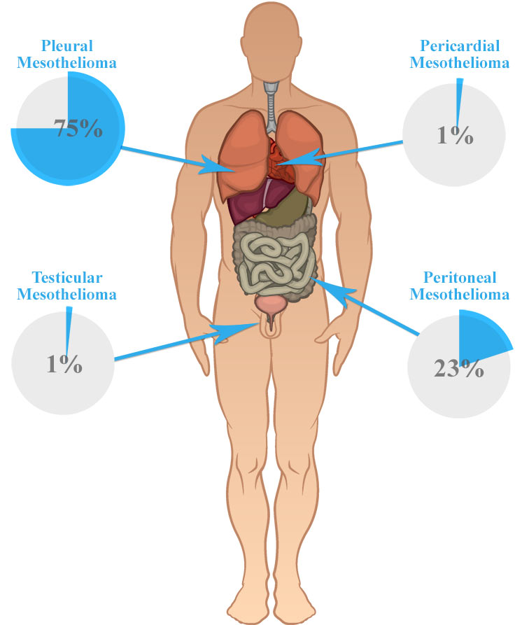 Types of Mesothelioma Cancer